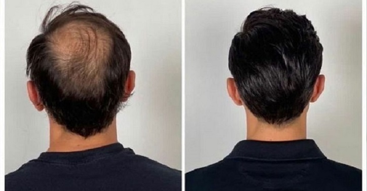Hair Weaving Service in Sivasagar-Guwahati-Dibrugarh-Assam